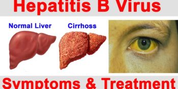 Hepatitis B